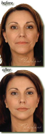 Restylane Treatment Before and After